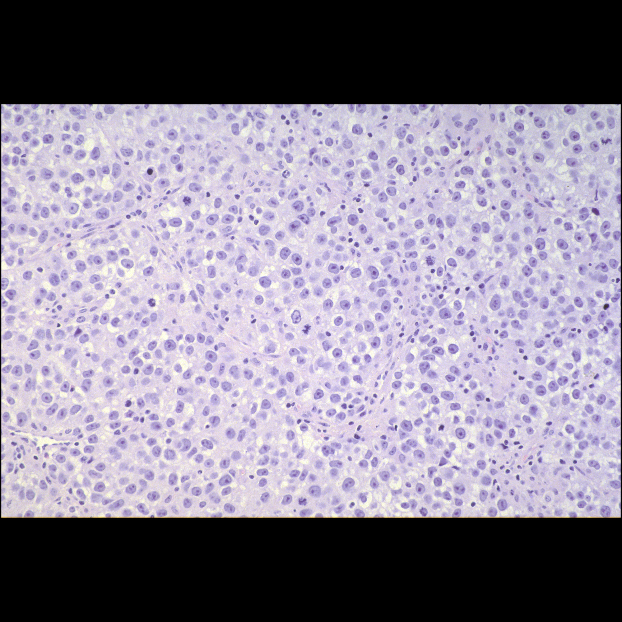 Mico Path OvarianTumor02CAP42DysgerminomaTorsedMicroPathThree | Pediatric ...