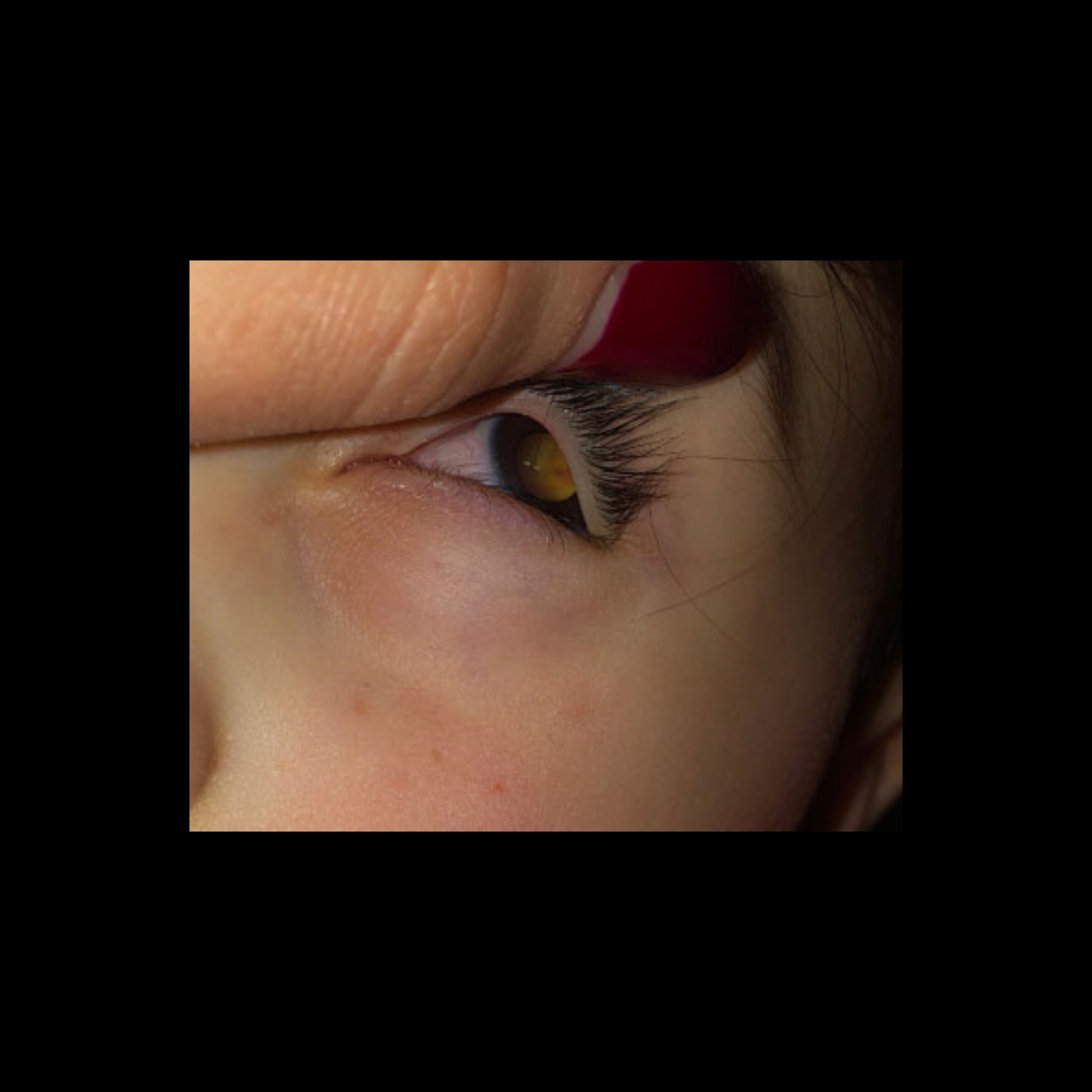 Fall Radiollgy Retinoblastoma02MDFallLeftPupilNonReactiveLeukocoriaHyperdenseLesionLef ...