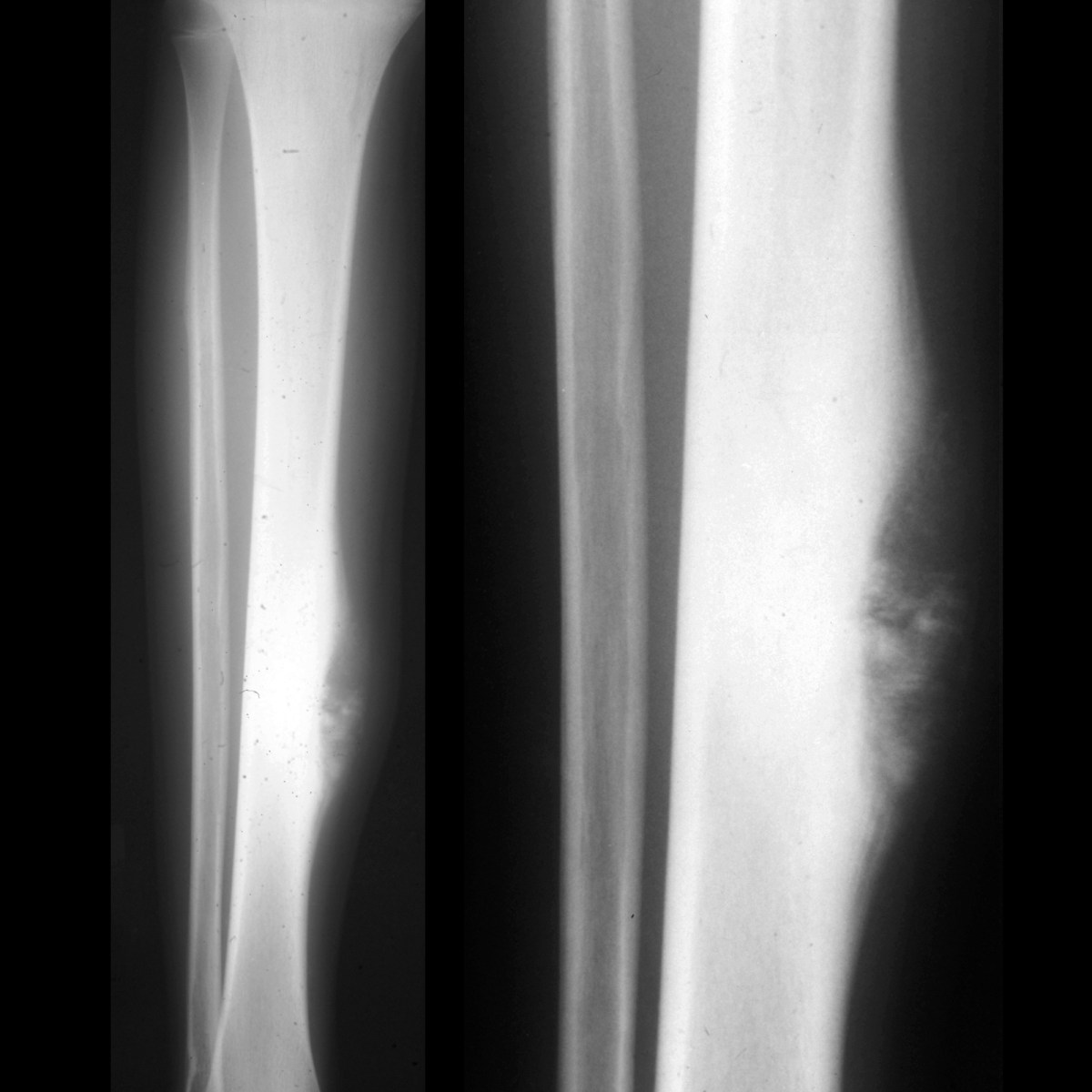 Teenager who after bumping their leg 1 year ago has had a painful lump ...
