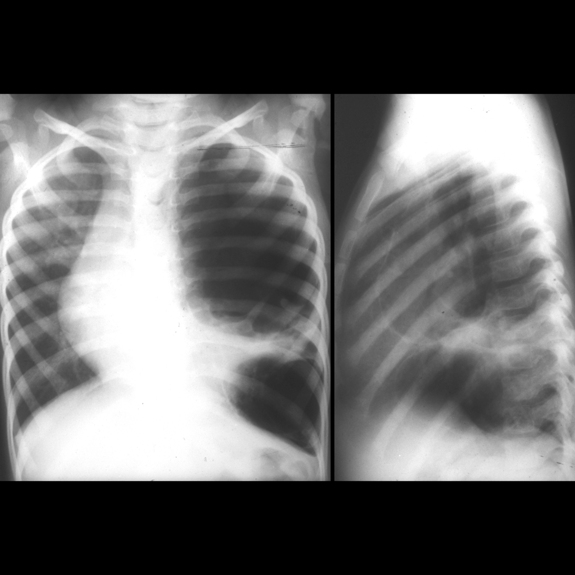 Congenital Pulmonary Airway Malformation | Pediatric Radiology ...