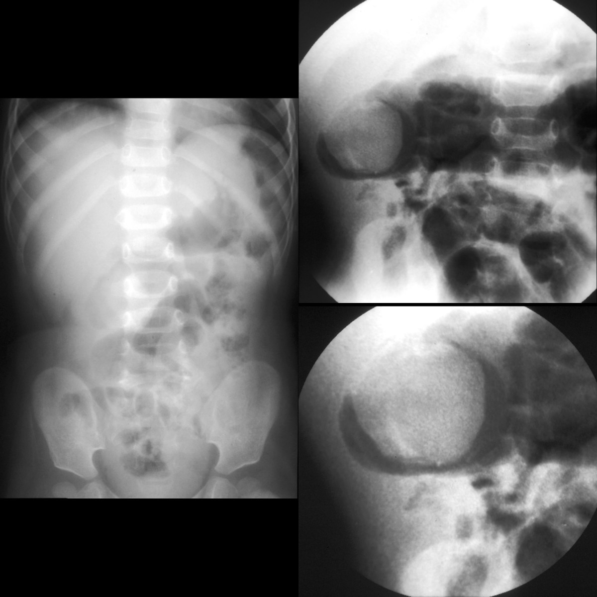 Toddler with crampy abdominal pain | Pediatric Radiology Case ...
