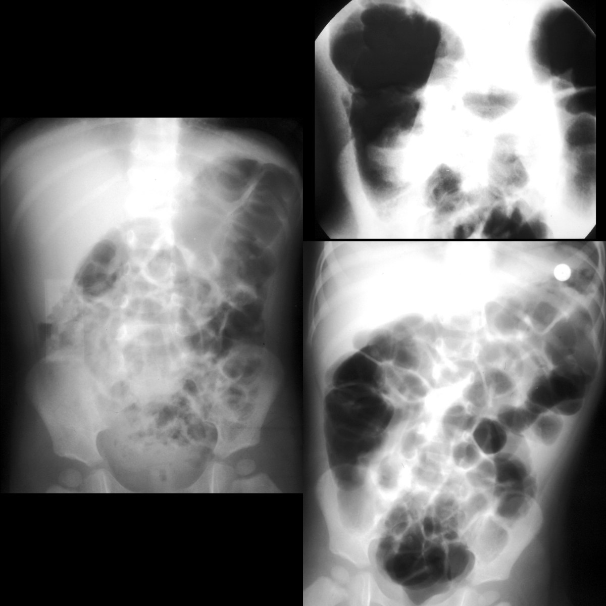 Toddler with bilious vomiting, crampy abdominal pain, bloody stools