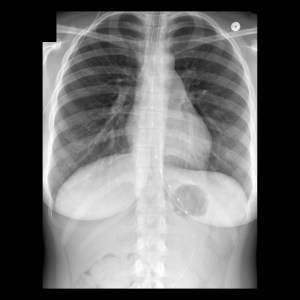 Ph Probe Radiograph Pediatric Esophageal pH Probe Malfunction | Pediatric Radiology ...