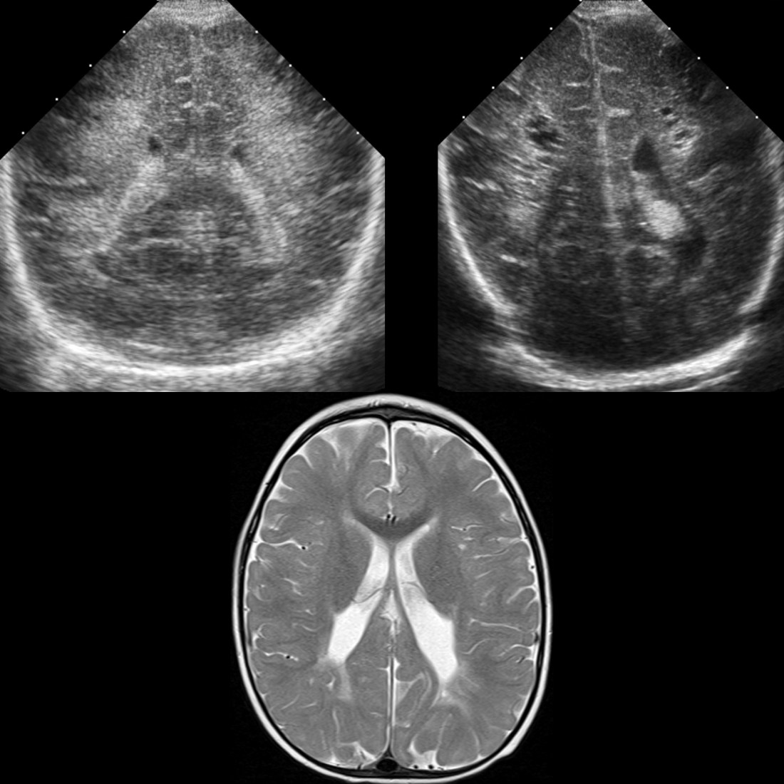 Periventricular Leukomalacia Pediatric Radiology Reference Article Periventricular Leukomalacia Pediatric Radiology Reference Article