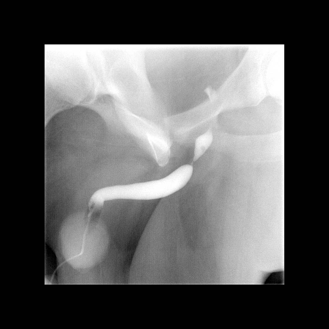 Normal Retrograde Urethrogram Transverse Pediatric Urethral Stricture | Pediatric Radiology Reference Article ...