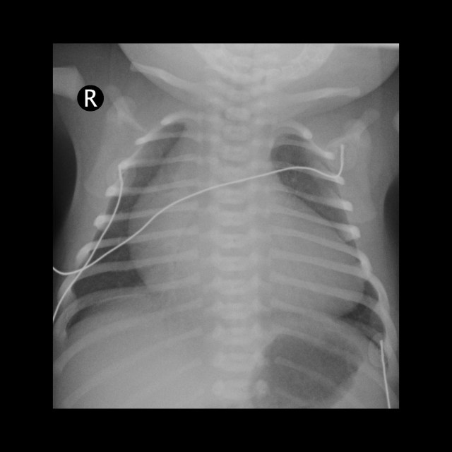CXR of Ebstein anomaly