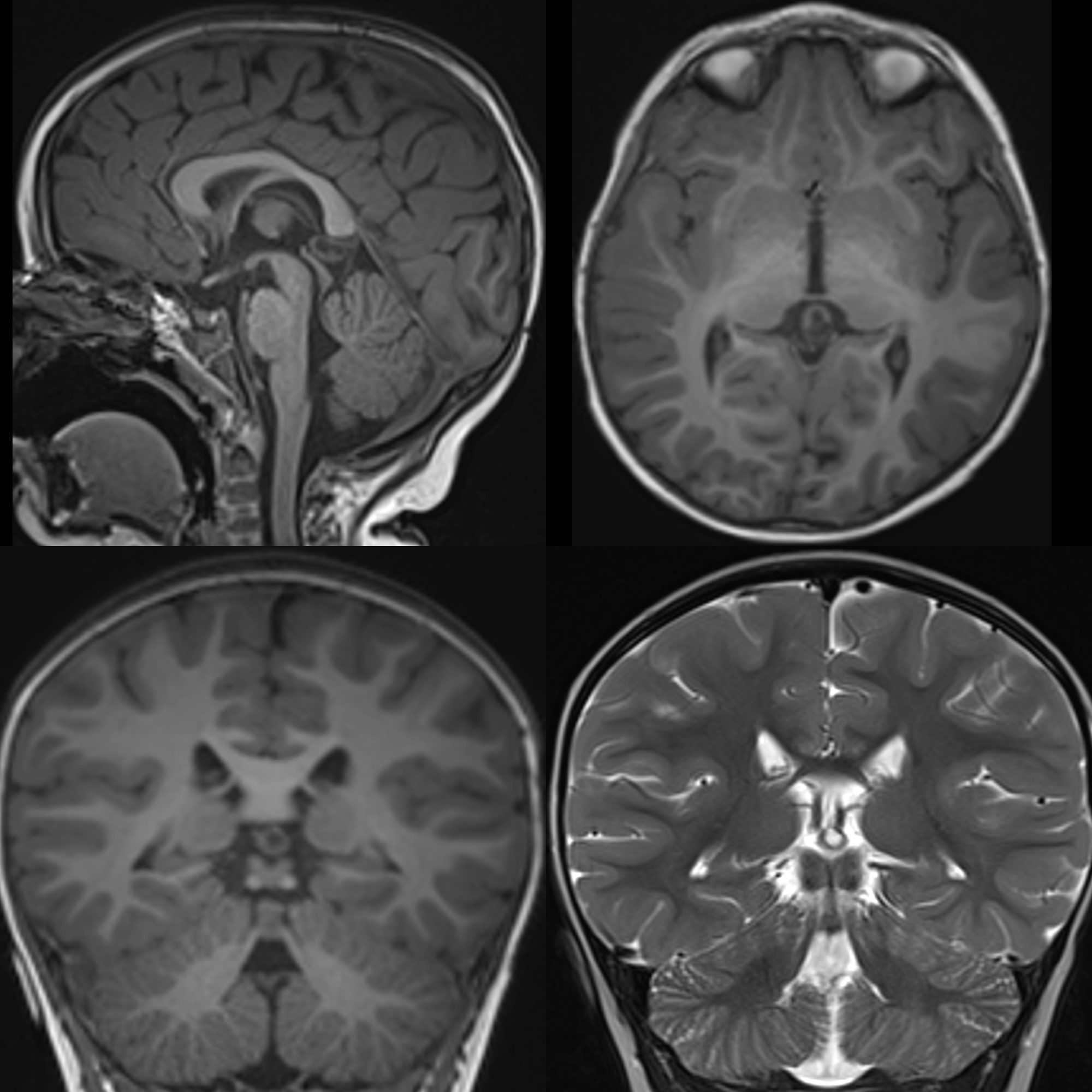 Pediatric Pineal Cyst Pediatric Radiology Reference Article
