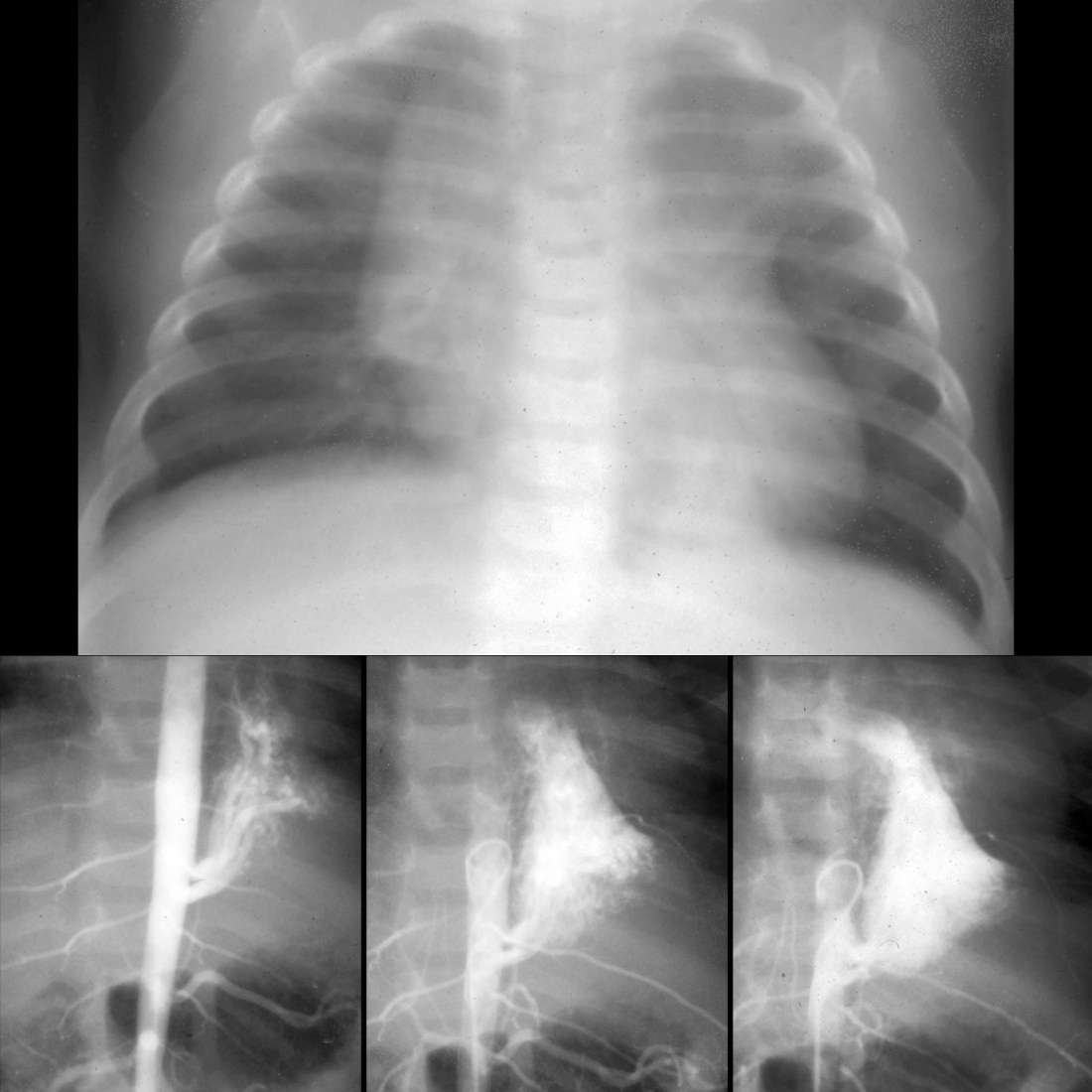 Pulmonary Sequestration