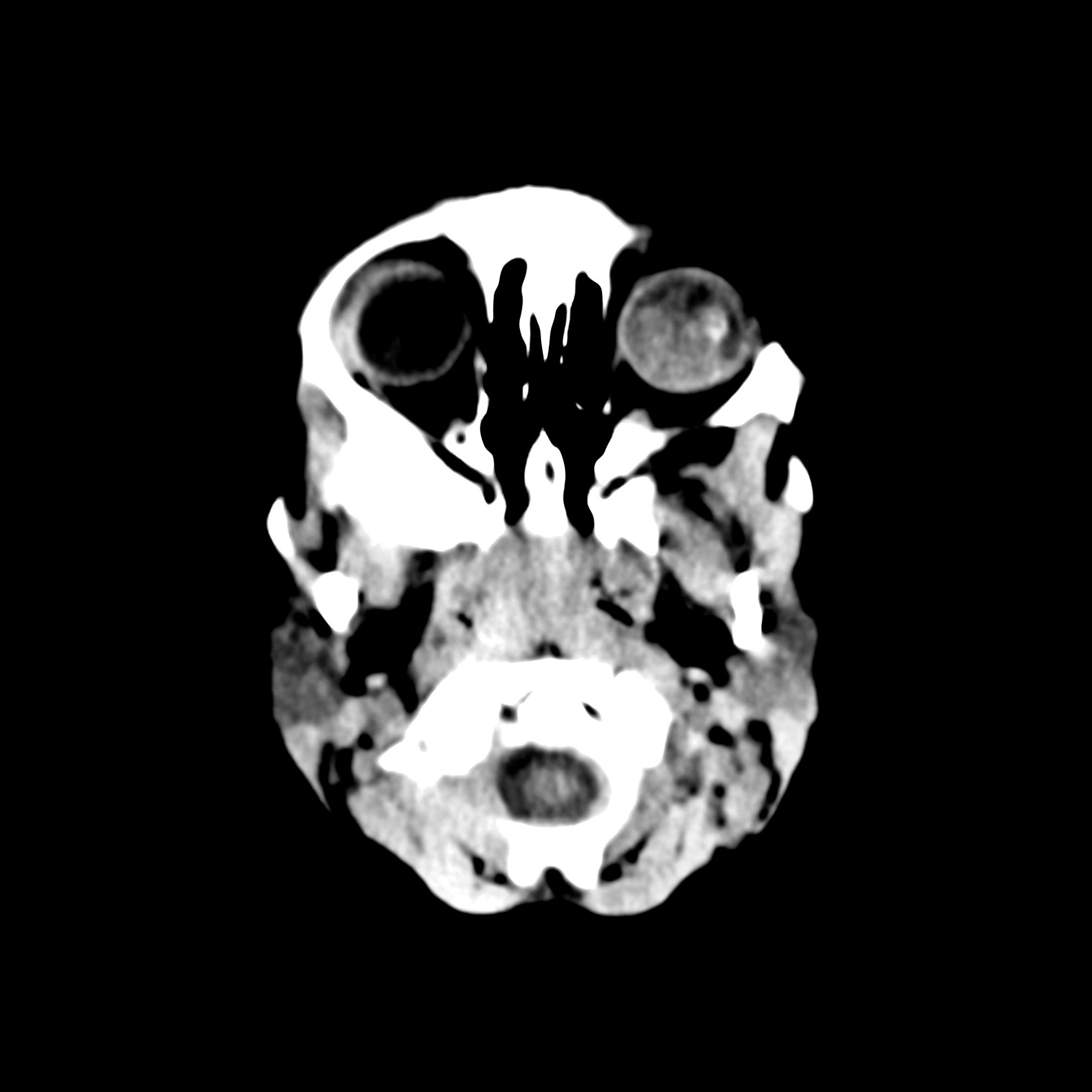 Fall Radiollgy Retinoblastoma02MDFallLeftPupilNonReactiveLeukocoriaHyperdenseLesionLef ...