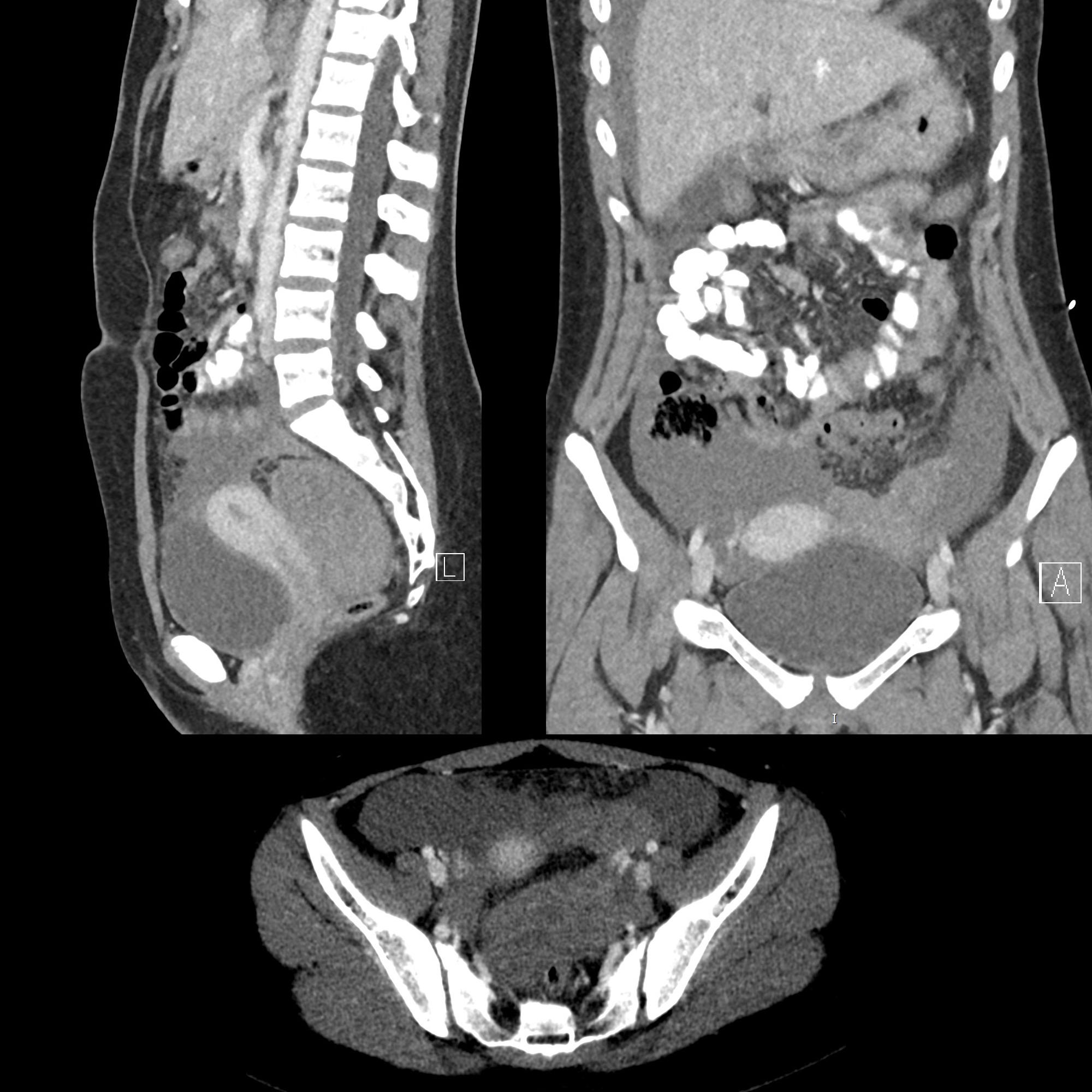 Pediatric Ectopic Pregnancy | Pediatric Radiology Reference Article ...