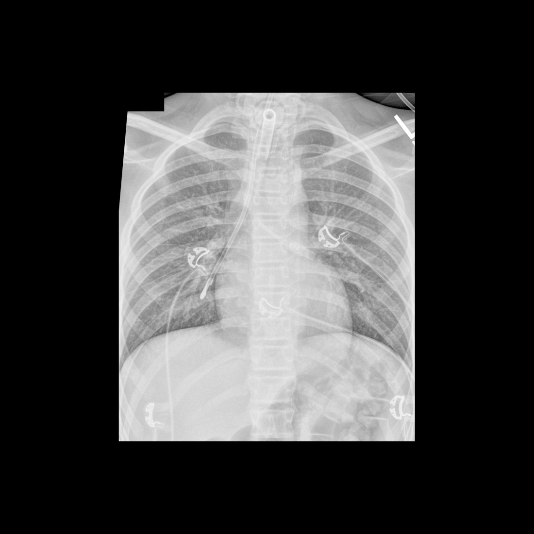 Misposition Pediatric Feeding Tube Malfunction / Malposition / Misposition ...