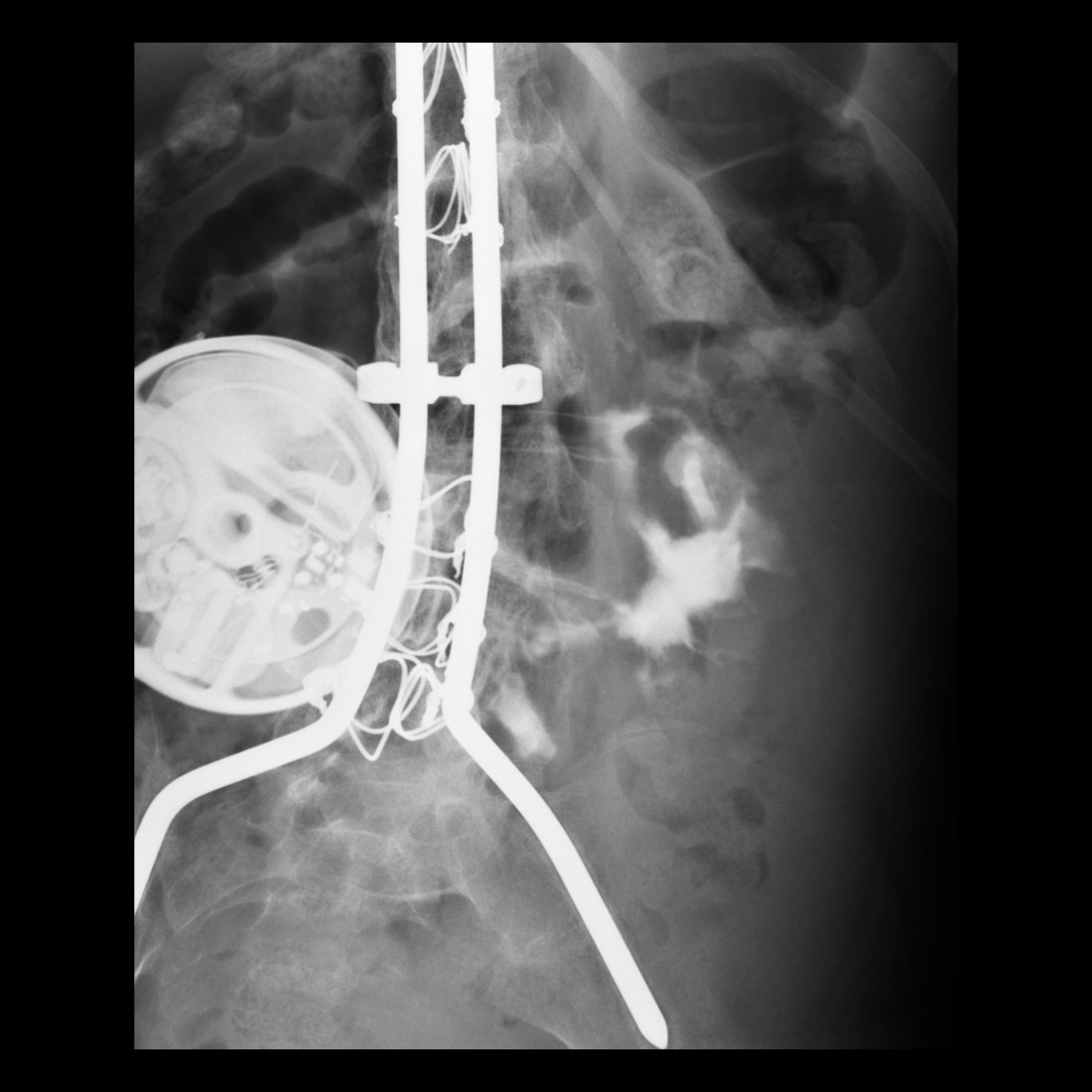 Pediatric Gastrojejunostomy Tube Malfunction / Malposition ...