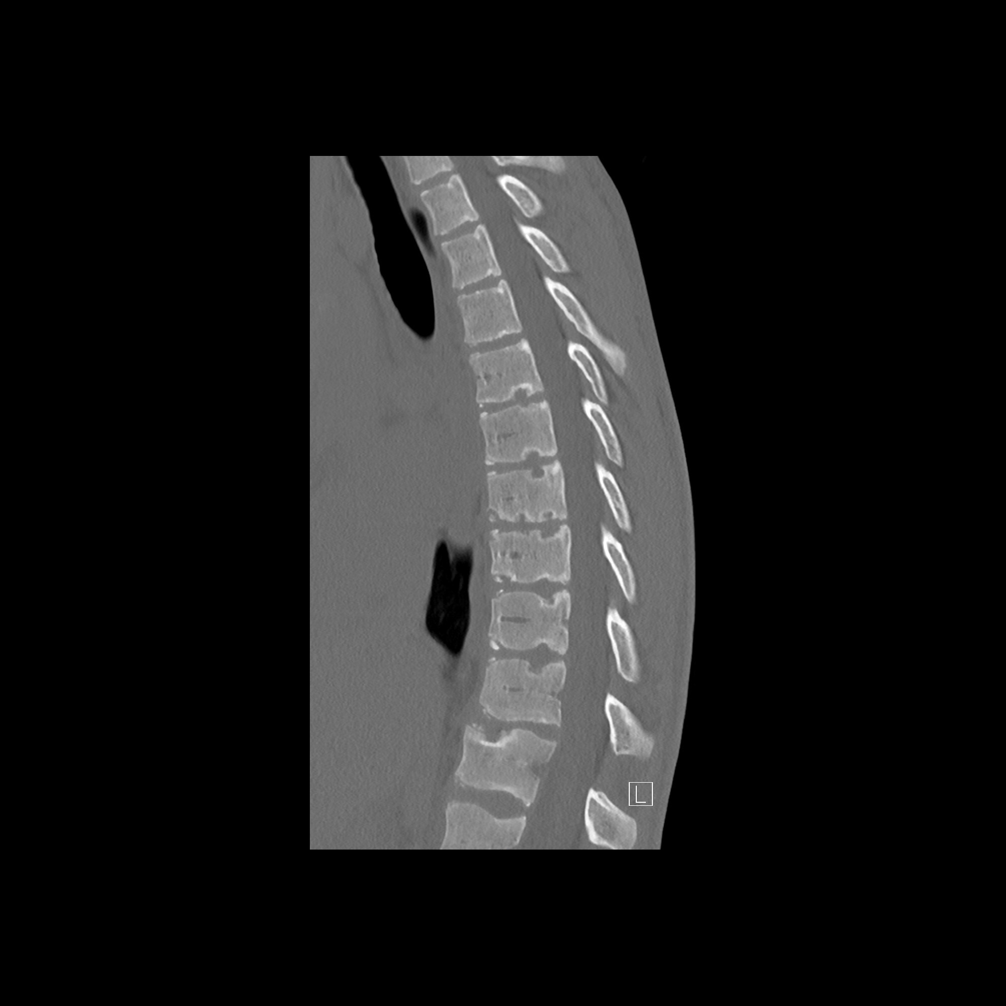 Pediatric Schmorl Nodes | Pediatric Radiology Reference Article