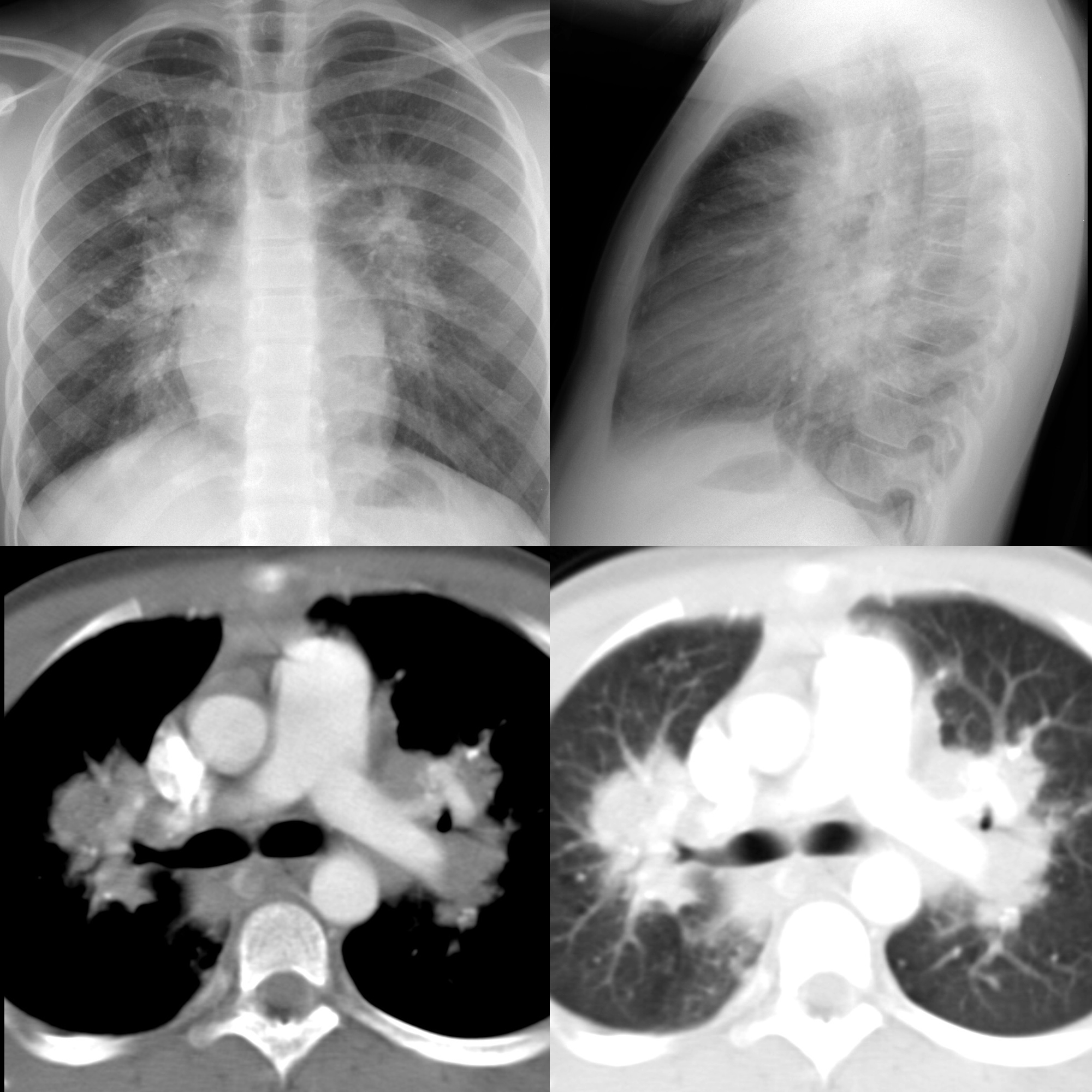 Pediatric Chronic Granulomatous Disease | Pediatric Radiology Reference ...