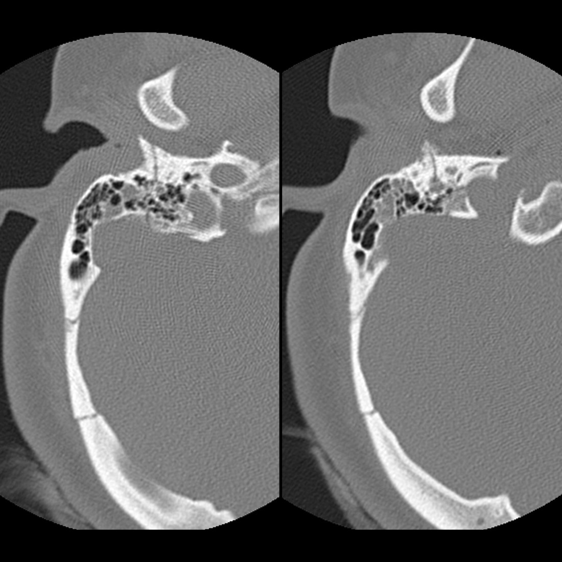 Pediatric Temporal Bone Fracture Pediatric Radiology Reference Pediatric Temporal Bone Fracture Pediatric Radiology Reference