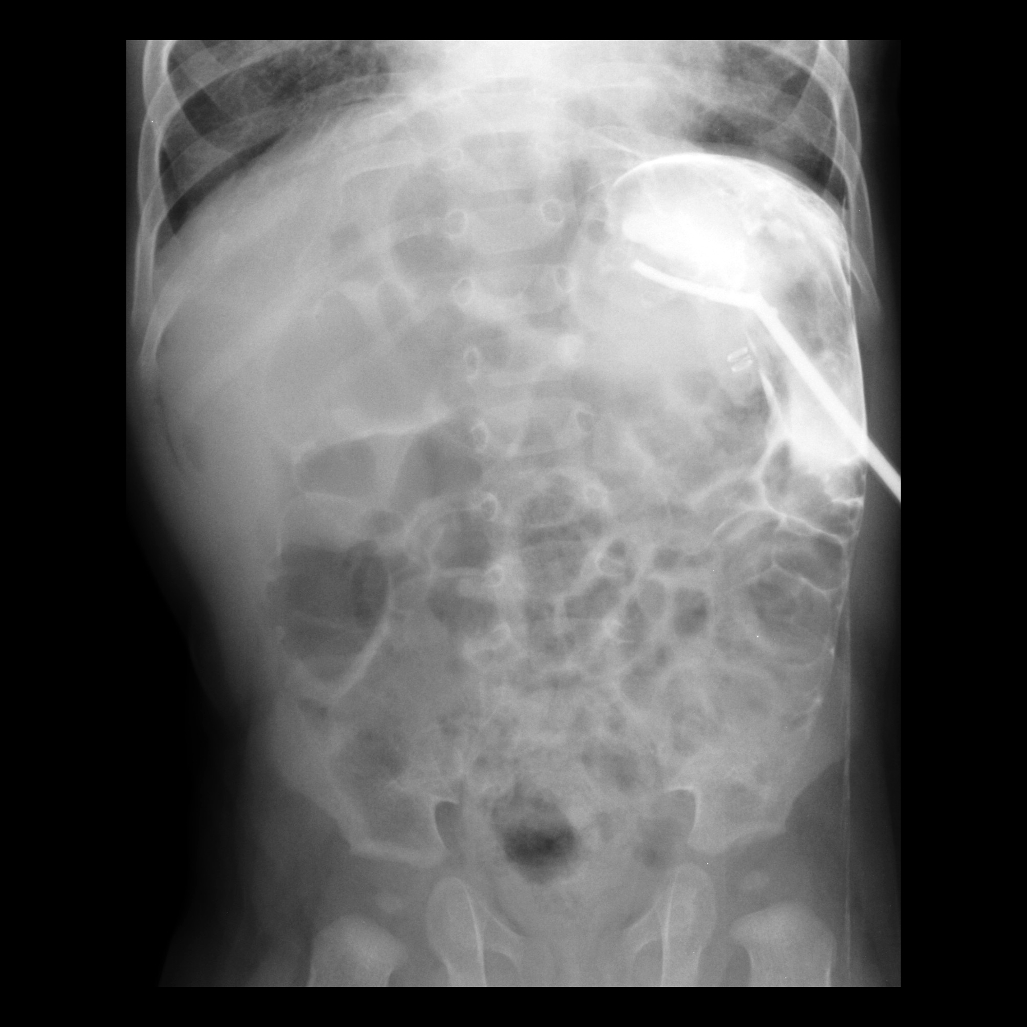Misposition Pediatric Gastrostomy Tube Malfunction / Malposition / Misposition ...