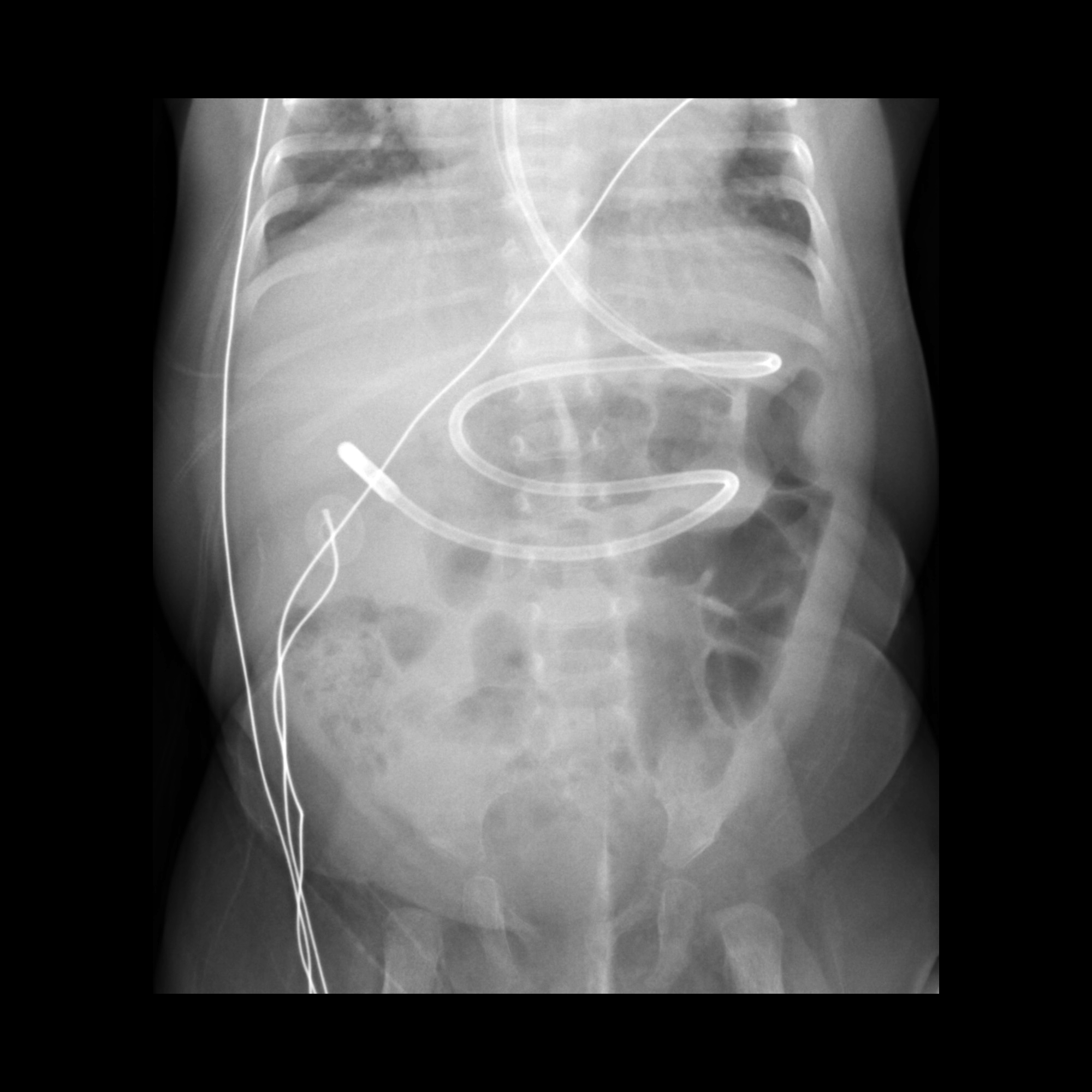 Misposition Pediatric Feeding Tube Malfunction / Malposition / Misposition ...