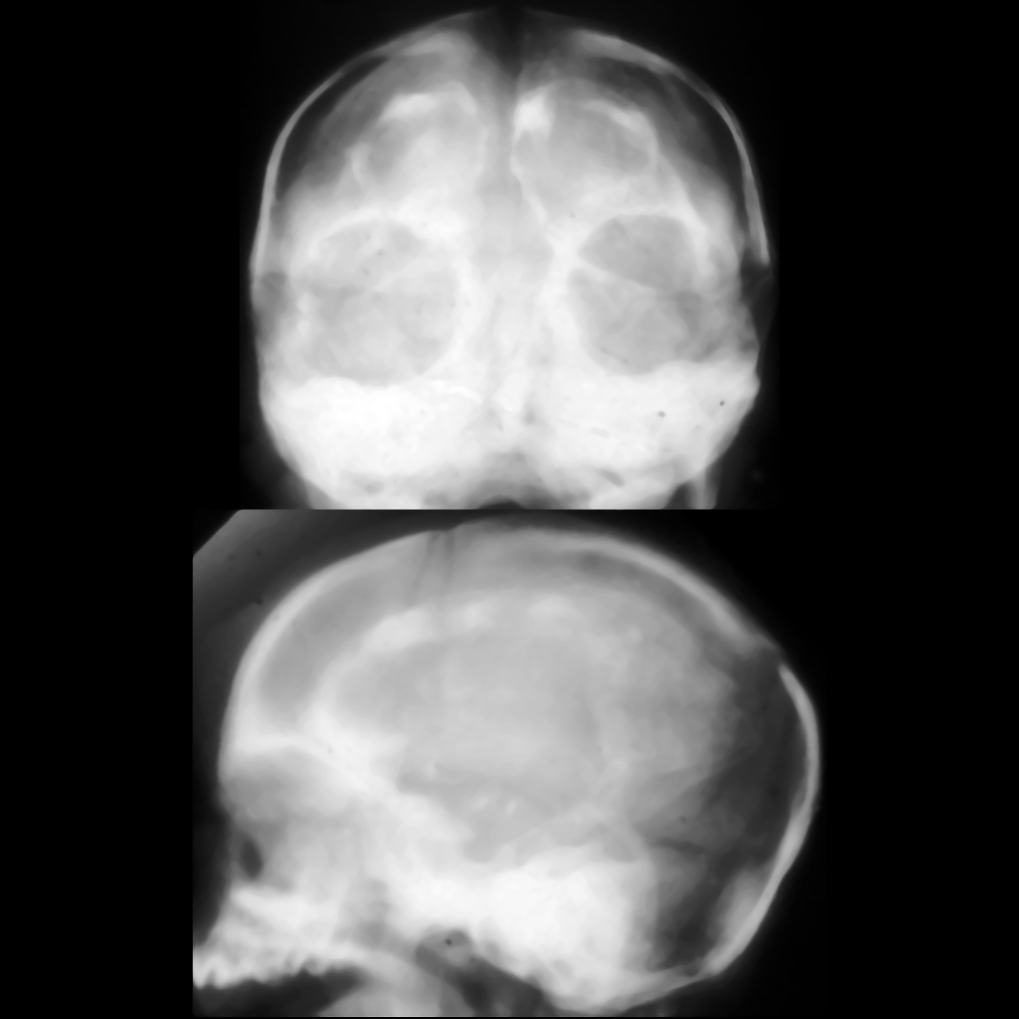 Blueberry Muffin Syndrome Radiopaedia