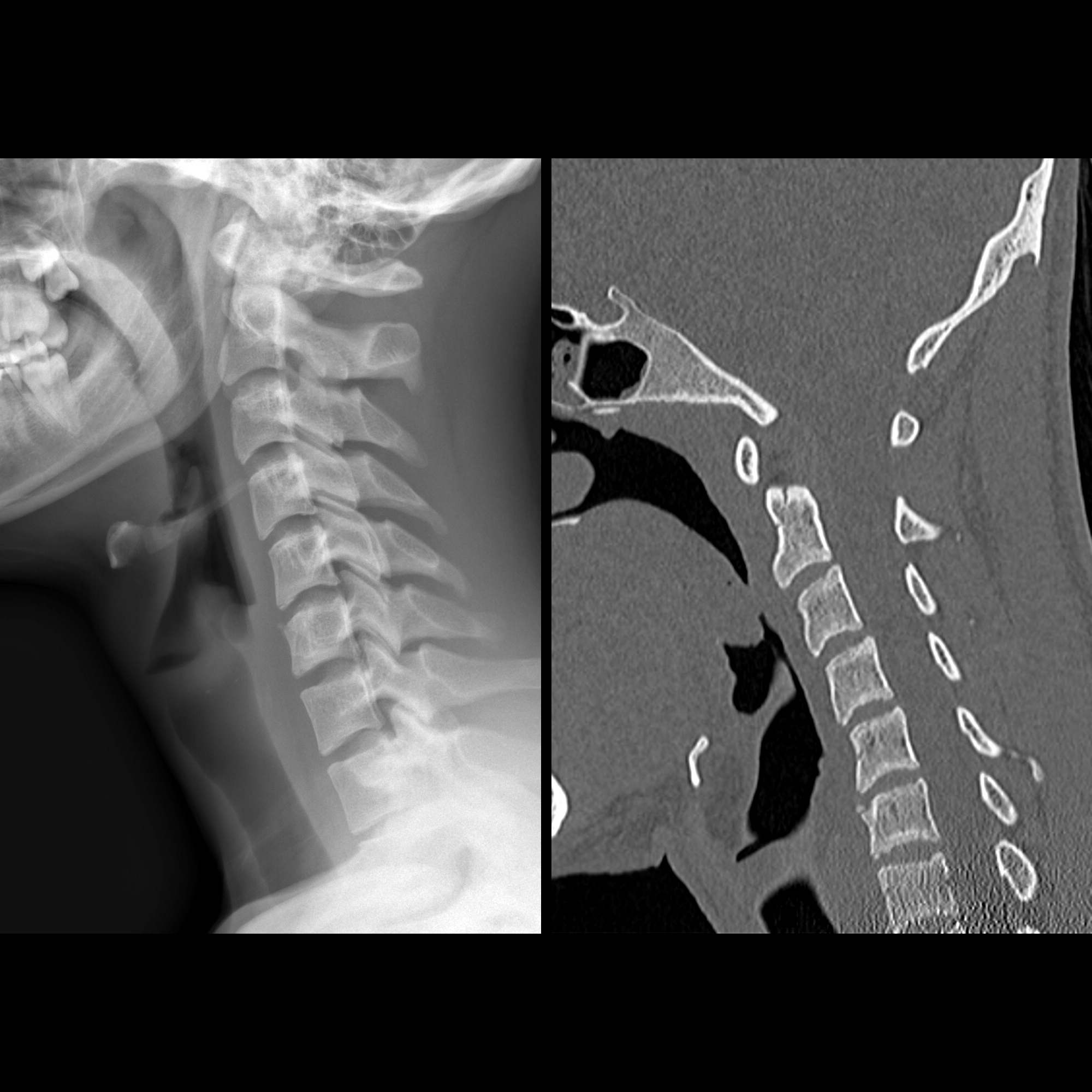 FractureCervicalSpine14MDHitOnBikeSmallFragmentAnteriorToC6NotFxProbabl ...