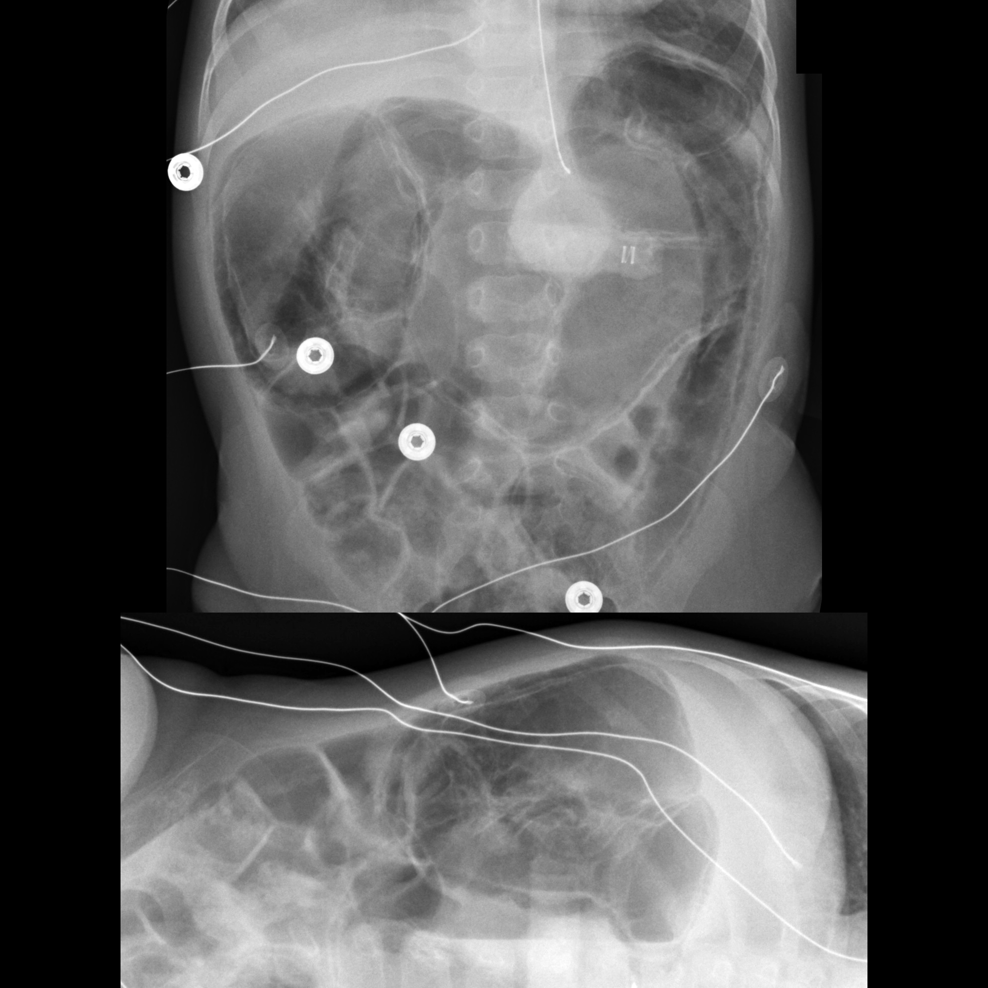 Des Radiology PneumatosisIntestinalis01MDRespDistressColonicPneumatosisAXRAPDecub9mo ...