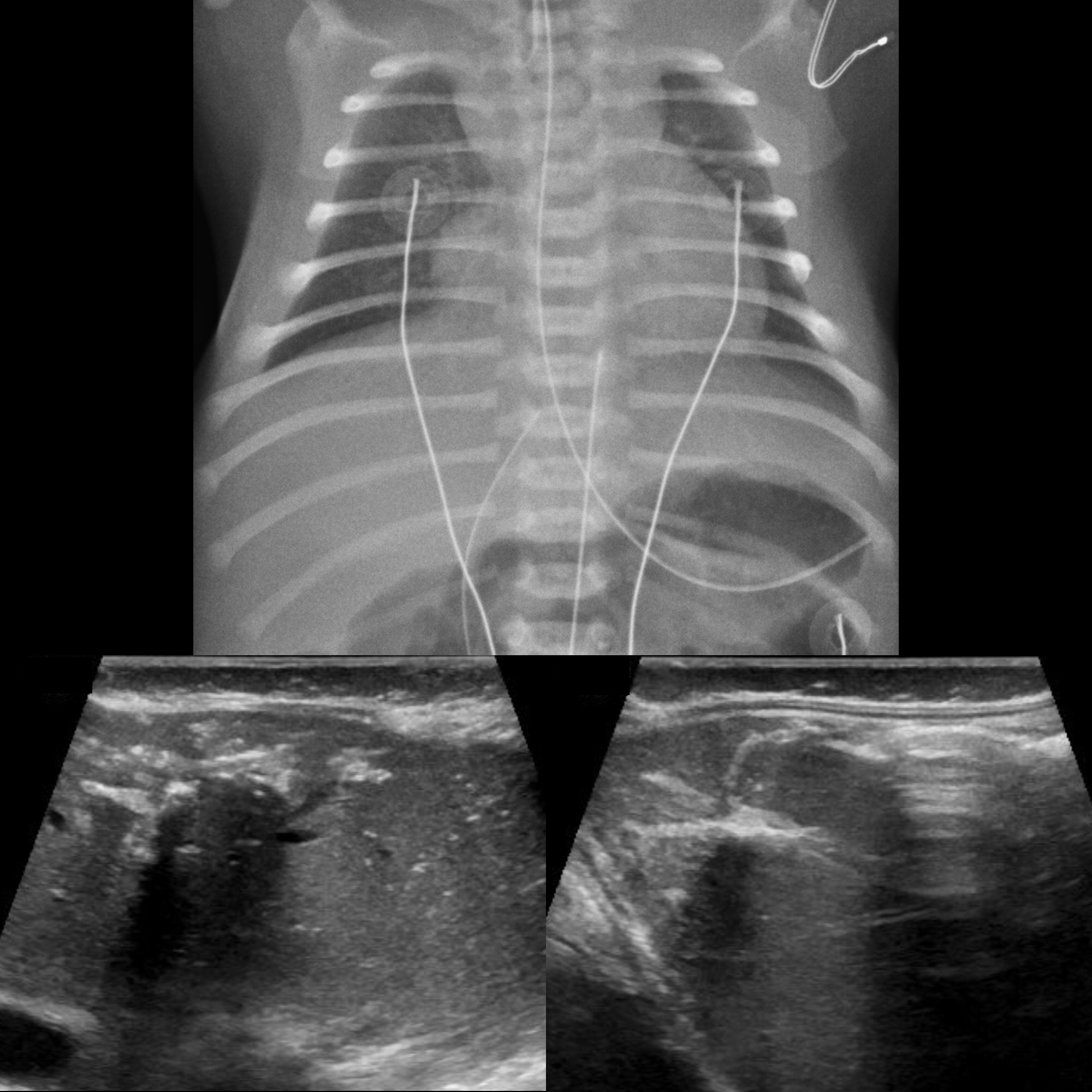 TPNoma02MDDueToUVCMalpositionInLeftPortalVeinHyperechoicBranchingLiverL ...