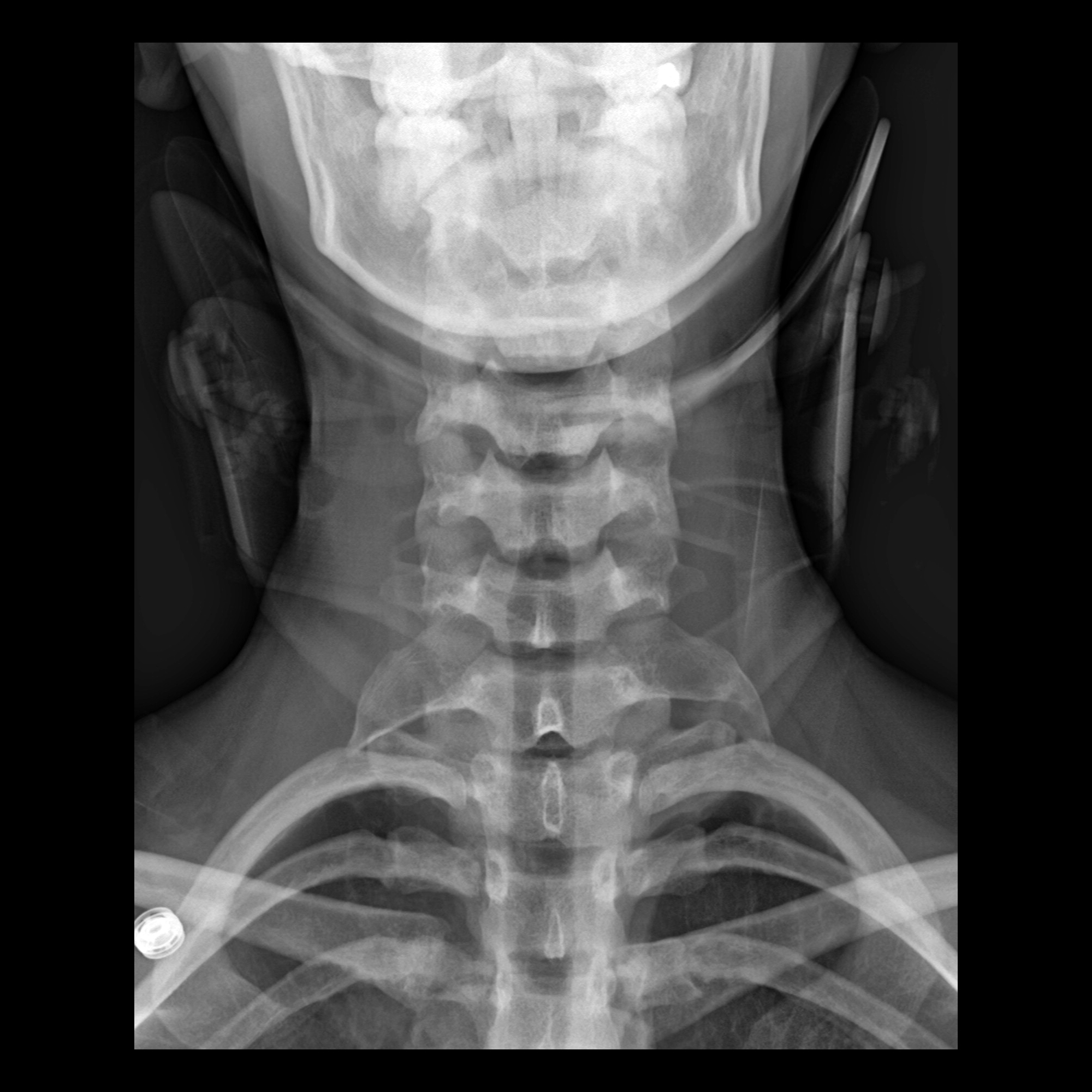 Pediatric Cervical Rib | Pediatric Radiology Reference Article ...