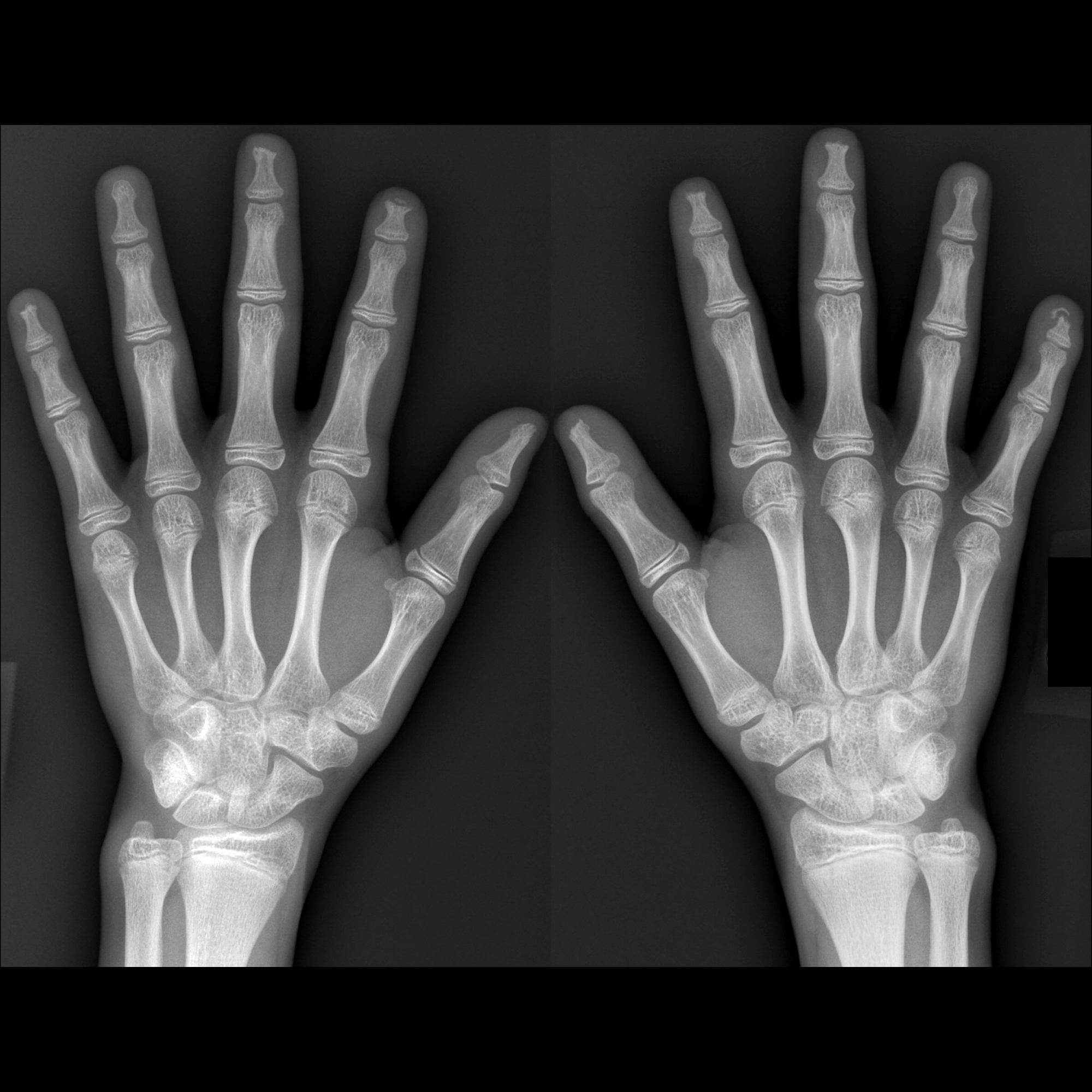 Scleroderma02MDAcroOsteolysisPln13yo | Pediatric Radiology Case ...