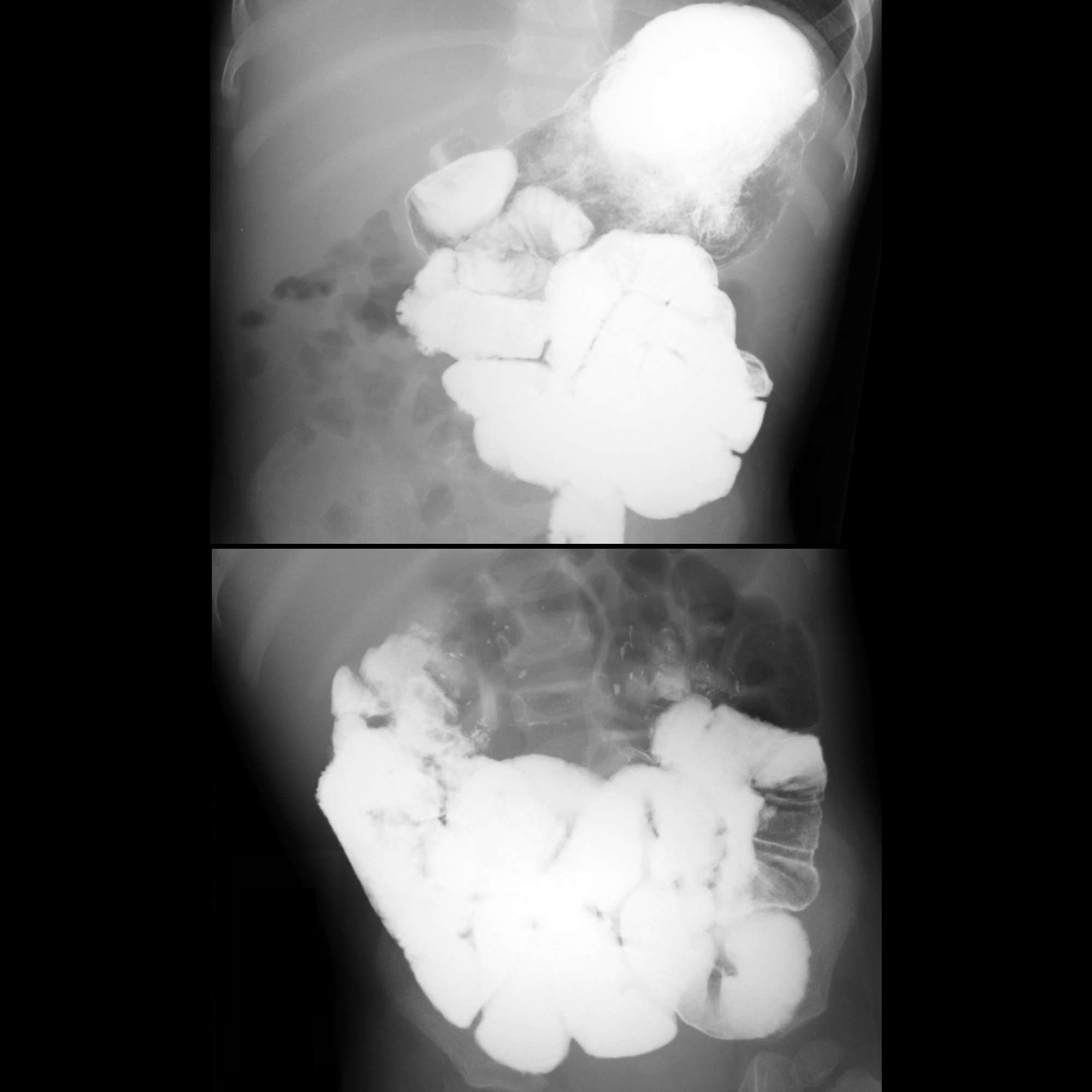 Sprue Radiology Sprue01MDCeliacDiseaseChronicDiarrheaFTTDilatedFeaturelessSmallBowelWit ...