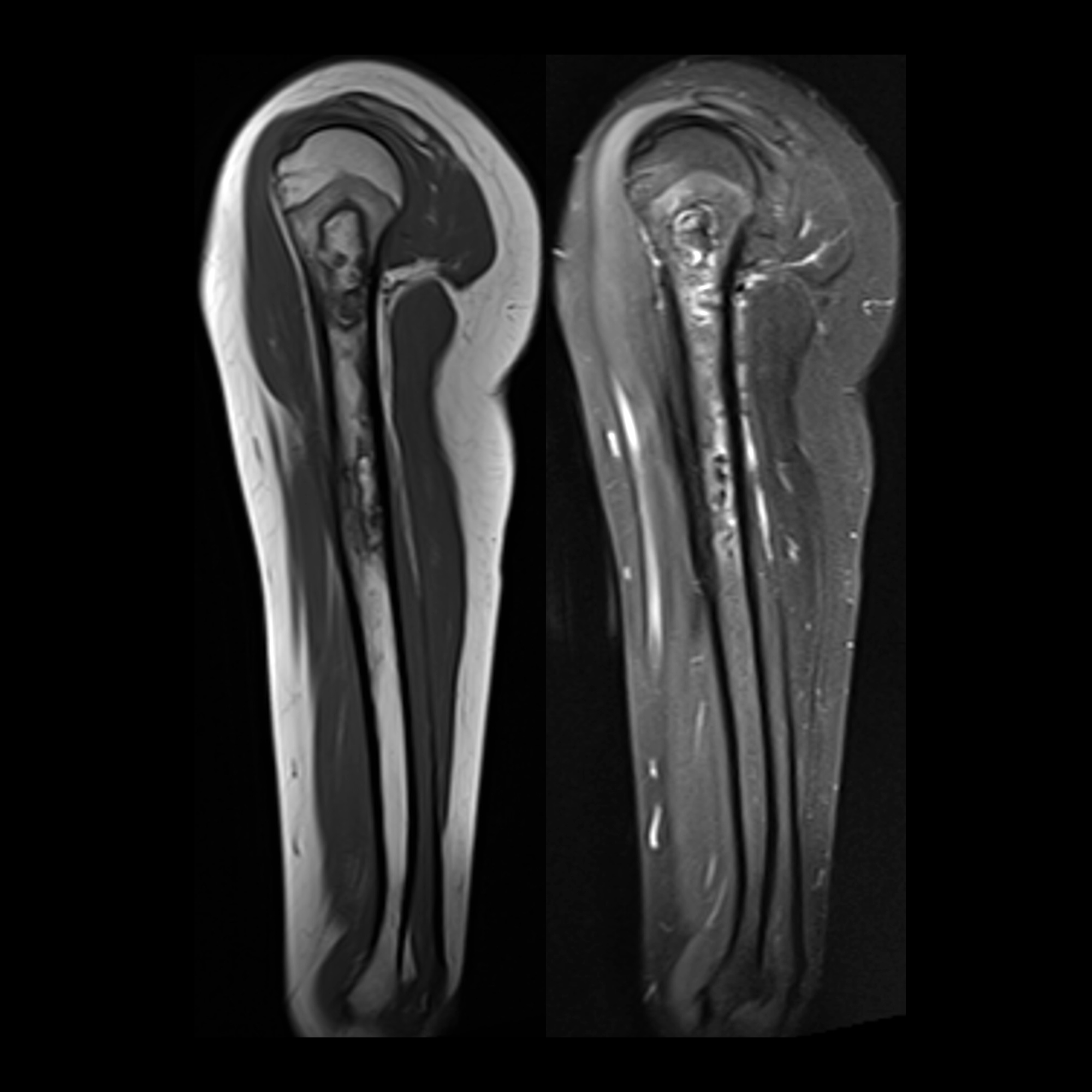 Pediatric Avascular Necrosis | Pediatric Radiology Reference Article ...
