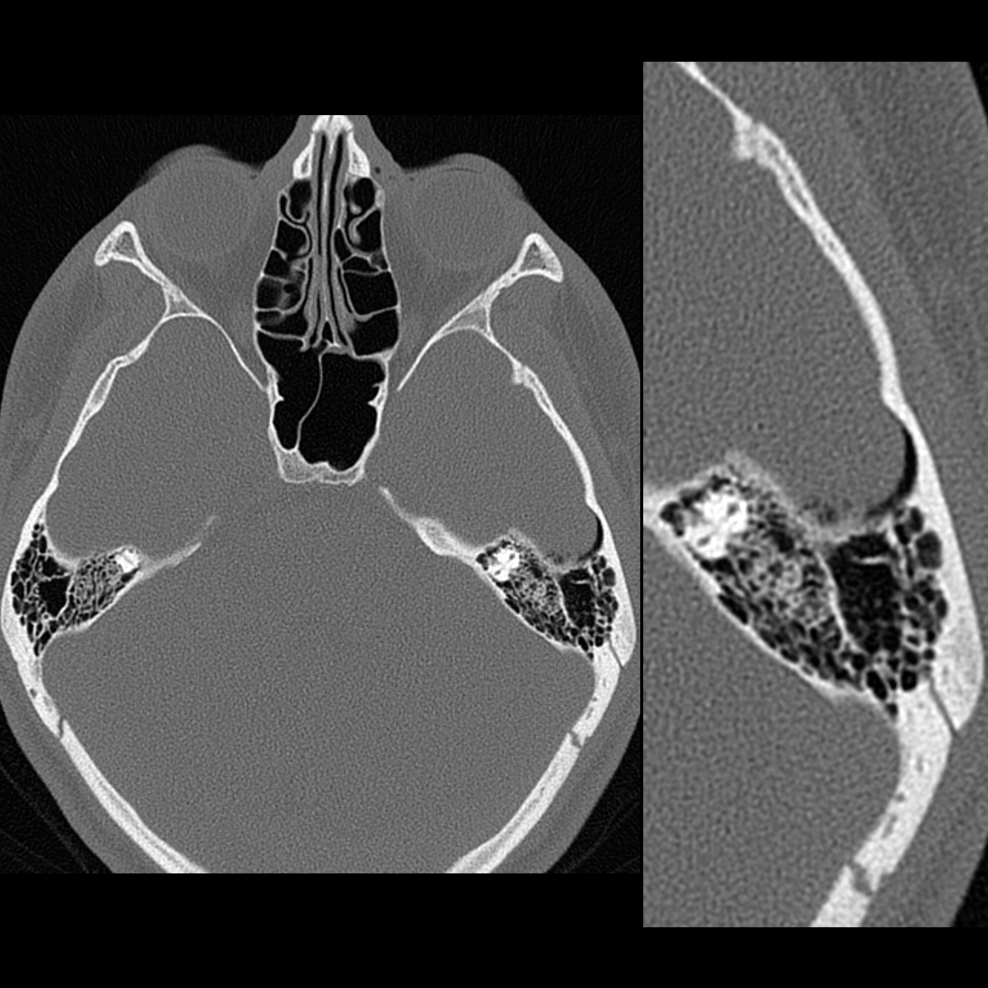 Fall Radiollgy FractureMastoid03MDFallLeftTemporalBoneMastoidSegmentWithPneumocephalus ...