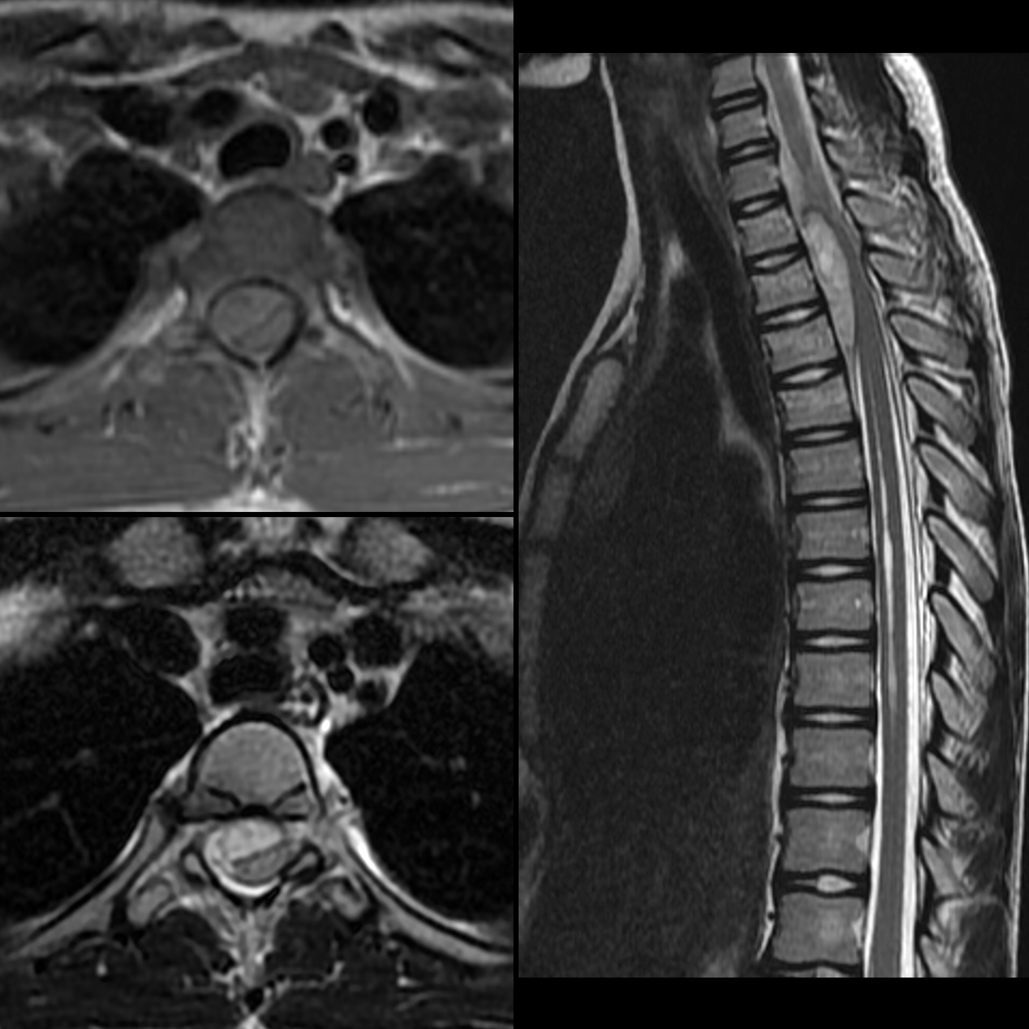 Pediatric Spinal Epidural Hematoma | Pediatric Radiology Reference ...
